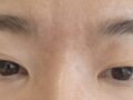 รีวิวการผ่าตัดแก้ไขแผลของ ดร.โด ออน-รก