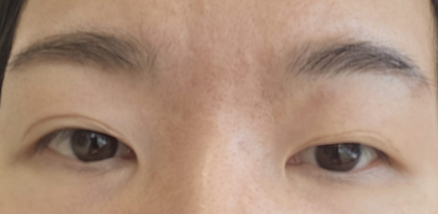 รีวิวการผ่าตัดแก้ไขแผลของ ดร.โด ออน-รก