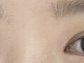 ผู้กำกับโด ออน-ร็อก - ศัลยกรรมแก้ไขสายตา