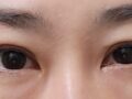 ผู้กำกับ นา ยองซู ศัลยกรรมตกแต่งเปลือกตาสองชั้นแบบธรรมชาติ การจัดตำแหน่งไขมันใต้ตาใหม่