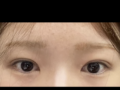 การผ่าตัดแก้ไขสายตาของผู้กำกับโด ออน-รก