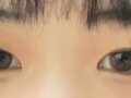 ฉันเข้ารับการผ่าตัดแก้ไขโดยผู้อำนวยการชเว บงกยู ที่โรงพยาบาลอิลมิริ