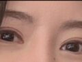 ศัลยกรรมแก้ไขการยึดเกาะตามธรรมชาติของผู้อำนวยการโด ออน-ร็อก
