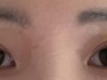 รีวิวการผ่าตัดแก้ไขสายตาของ ดร.โด ออน-รก
