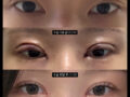 รีวิวการผ่าตัดแก้ไขสายตาของ ดร.คิม ฮงจิน