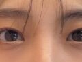 ฉันเข้ารับการผ่าตัดตาที่คลินิกของผู้อำนวยการโด!