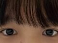 รีวิวการผ่าตัดเปลือกตาบนแบบไม่ใช้มีดกรีดของ ดร. โด ออน-ร็อก