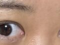 การผ่าตัดแก้ไขสายตาของผู้กำกับโด ออน-รก