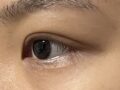 道言録院長、埋没+ウィットイム