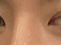 รีวิวการผ่าตัดตาของ ดร.โด ออน-ร็อก