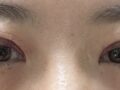 รีวิวการผ่าตัดทำตาสองชั้นของ ดร.คิม ฮงจิน