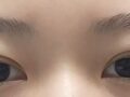 รีวิวการผ่าตัดตาโดย ดร.คิม ฮงจิน