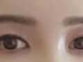 ศัลยกรรมตกแต่งเปลือกตาสองชั้นแบบไม่ผ่าตัด