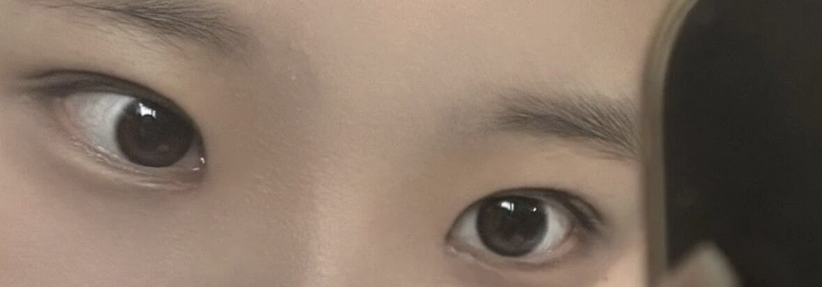 ศัลยกรรมตกแต่งเปลือกตาสองชั้น