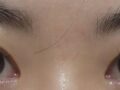 การผ่าตัดแก้ไขสายตาของผู้กำกับโด ออน-รก