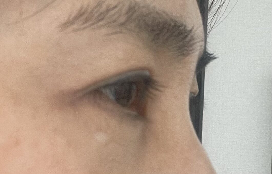 การผ่าตัดเปลือกตาล่าง 1 มม.