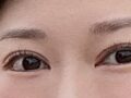 รีวิวการผ่าตัดแก้ไขดวงตาขนาด 1 มม.