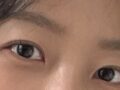 การผ่าตัดแก้ไขดวงตาขนาด 1 มม. โดย ดร. คิม ฮงจิน: รีวิวหลังการผ่าตัด 2.5 เดือน