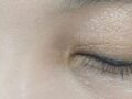 1毫米整形手术矫正上睑下垂、双眼皮