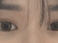 ศัลยกรรมตกแต่งเปลือกตาสองชั้น