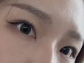การยกกระชับเปลือกตาบนด้วยการติดวัสดุธรรมชาติเพื่อสร้างชั้นตาสองชั้น