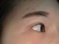 都彦禄院长  双眼皮修复 术后反馈