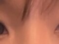 อิลมิริ ดาวอนร็อก ศัลยกรรมตกแต่งเปลือกตาสองชั้นแบบไม่ต้องกรีด