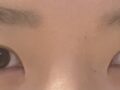 一毫米  自然粘连  术后反馈