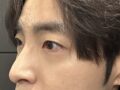 （目の矯正）一ミリ整形外科キム・ホンジン院長先生
