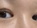 都彦禄院长 做的双眼皮修复反馈