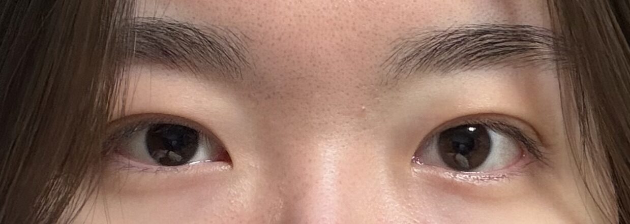 หลังการผ่าตัด