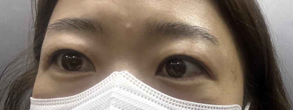 眉毛藻術+自然癒着レビュー