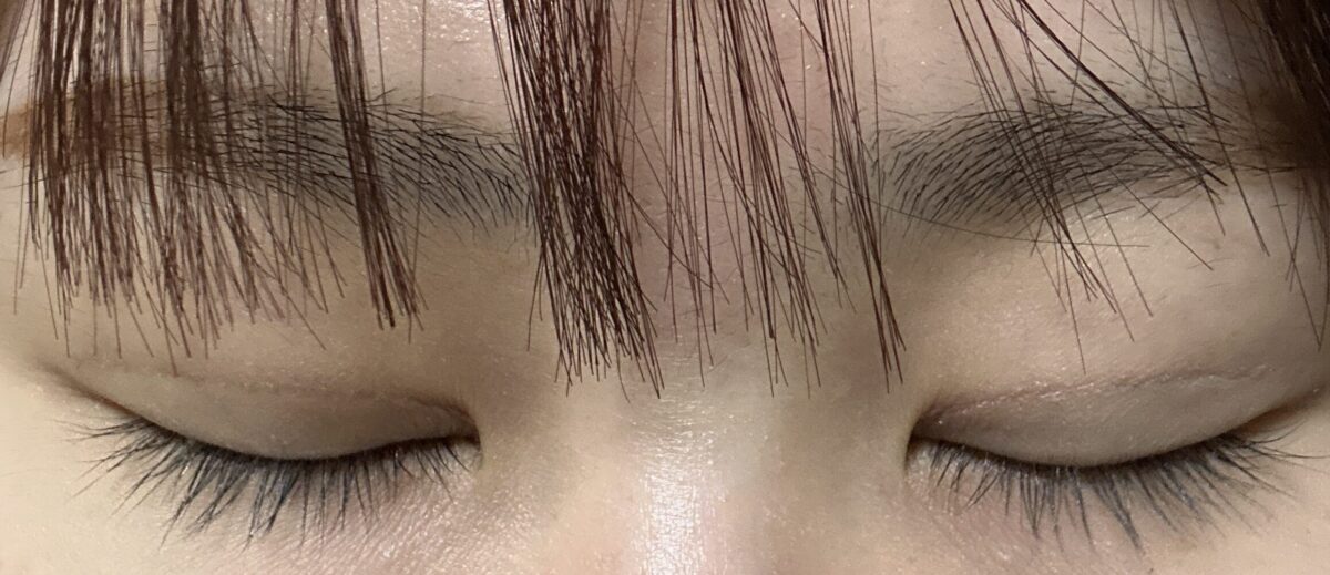二重まぶた切開後期