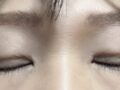 自然粘连+上眼睑+切眉提升