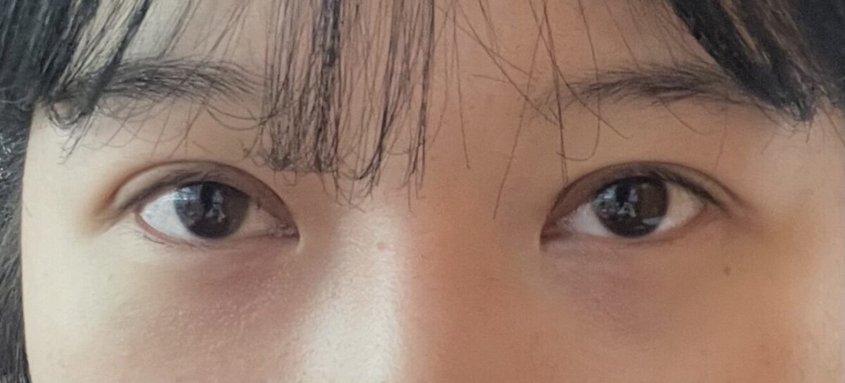 目元形成術