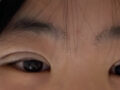埋线双眼皮+上眼角+眼睑提肌