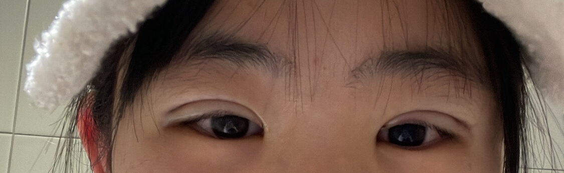 ศัลยกรรมตกแต่งเปลือกตาแบบไม่ต้องกรีด + ยกเปลือกตาบน + แก้ไขรูปทรงดวงตา