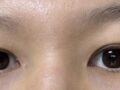 การแก้ไขเปลือกตา + ศัลยกรรมตกแต่งเปลือกตาแบบสองชั้น (In-out double eyelid surgery)