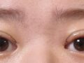 รีวิวการผ่าตัดทำตาสองชั้น (เย็บซ่อนไหม)
