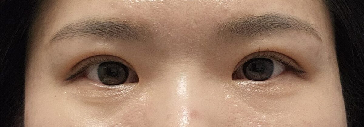 非切開自然癒着+ウィットイムレビュー