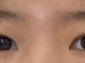 ศัลยกรรมตกแต่งเปลือกตาสองชั้น + การแก้ไขรูปทรงดวงตา