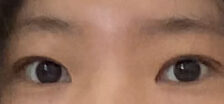 ศัลยกรรมตกแต่งเปลือกตาสองชั้น + การแก้ไขรูปทรงดวงตา