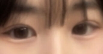 ผู้กำกับ โด ออน-ร็อก ศัลยกรรมตกแต่งเปลือกตา (เย็บปิดแผลด้านใน-ด้านนอก) ยกกระชับเปลือกตาบน แก้ไขรูปทรงดวงตา