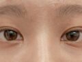 รีวิวการผ่าตัดแก้ไขรอยแผลเป็นที่ดวงตา
