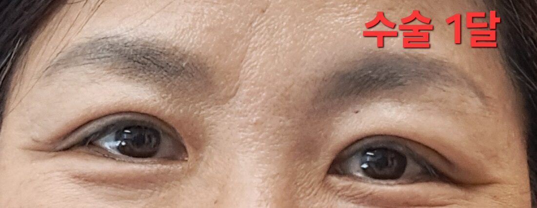 ศัลยกรรมตกแต่งเปลือกตาแบบกรีด (ยุค 50)