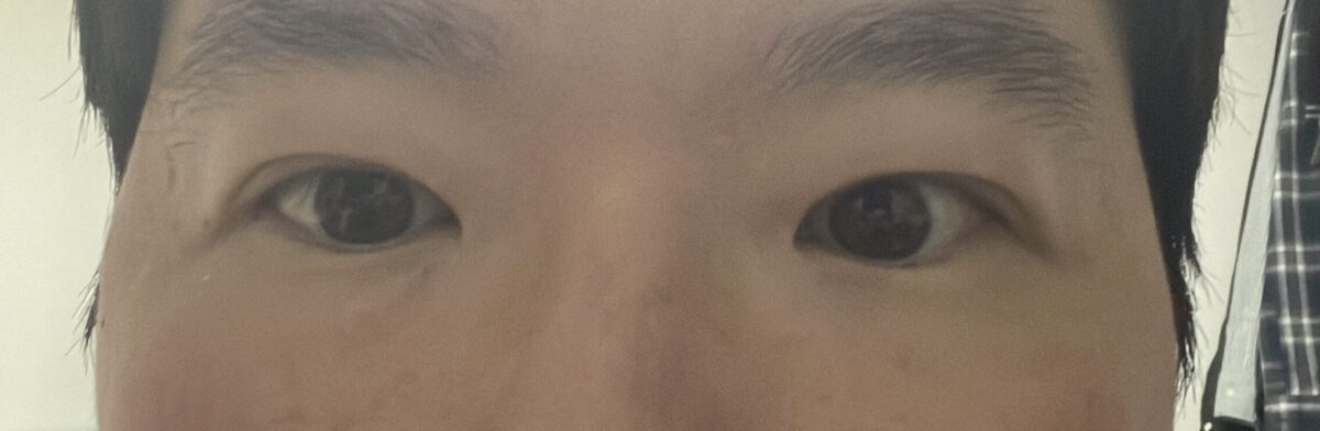 双数のレビュー（切開/目の矯正/ウィット）1ヶ月目