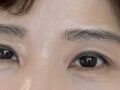 Đánh giá đường khâu bị chôn vùi