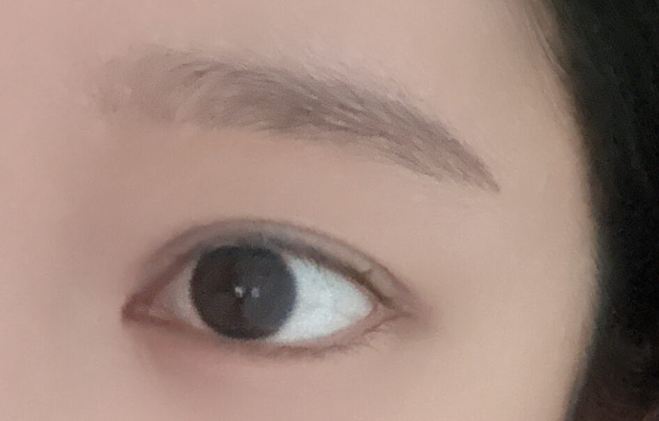 初眼  自然粘连+上眼角 术后反馈