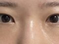 การแก้ไขเปลือกตาโดยไม่ต้องผ่าตัด + การจัดตำแหน่งไขมันใต้ตาใหม่ - ผู้กำกับ คิม ฮงจิน