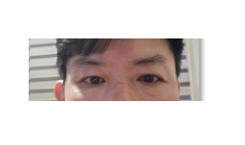 金洪振院长  50多岁男士的眼睑下垂手术后反馈